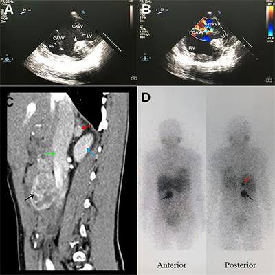 Co-Occurrence of Pheochromocytoma-Paraganglioma and Cyanotic Congenital Heart Disease: A Case Report and Literature Review